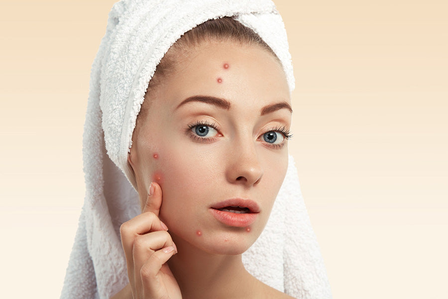 Korean Pimple Patches Cosrx Master Anti-Acne Stickers blemishes blackheads whiteheads to heal overnight K Beauty World